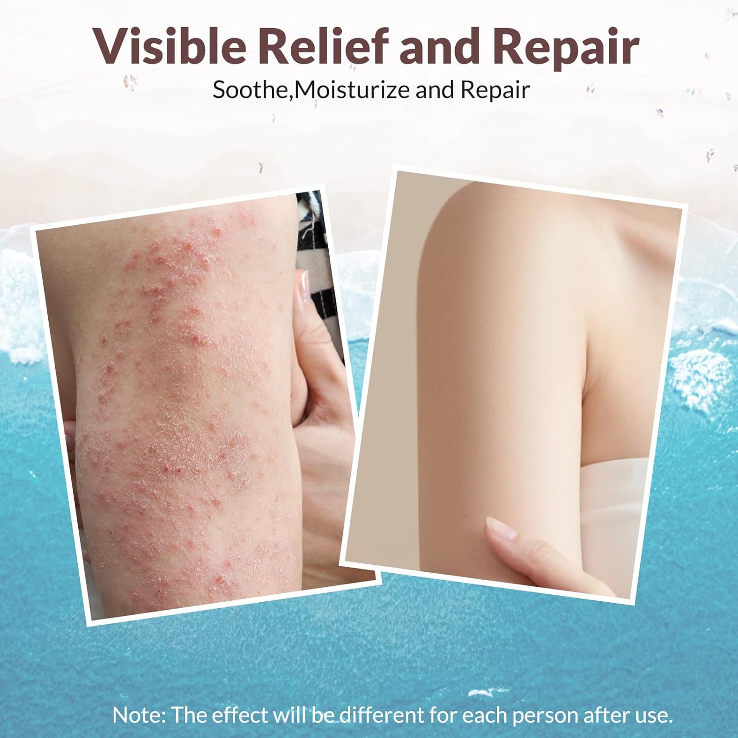 DermaMoss: Nature's Eczema Eradication Protocol