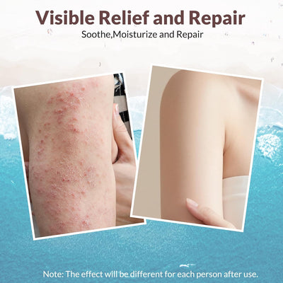 DermaMoss: Nature's Eczema Eradication Protocol