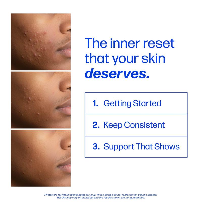 Clear Skin Acne Supplement - Clear Acne From The Source