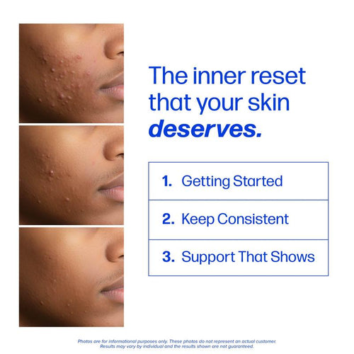 Clear Skin Acne Supplement - Clear Acne From The Source